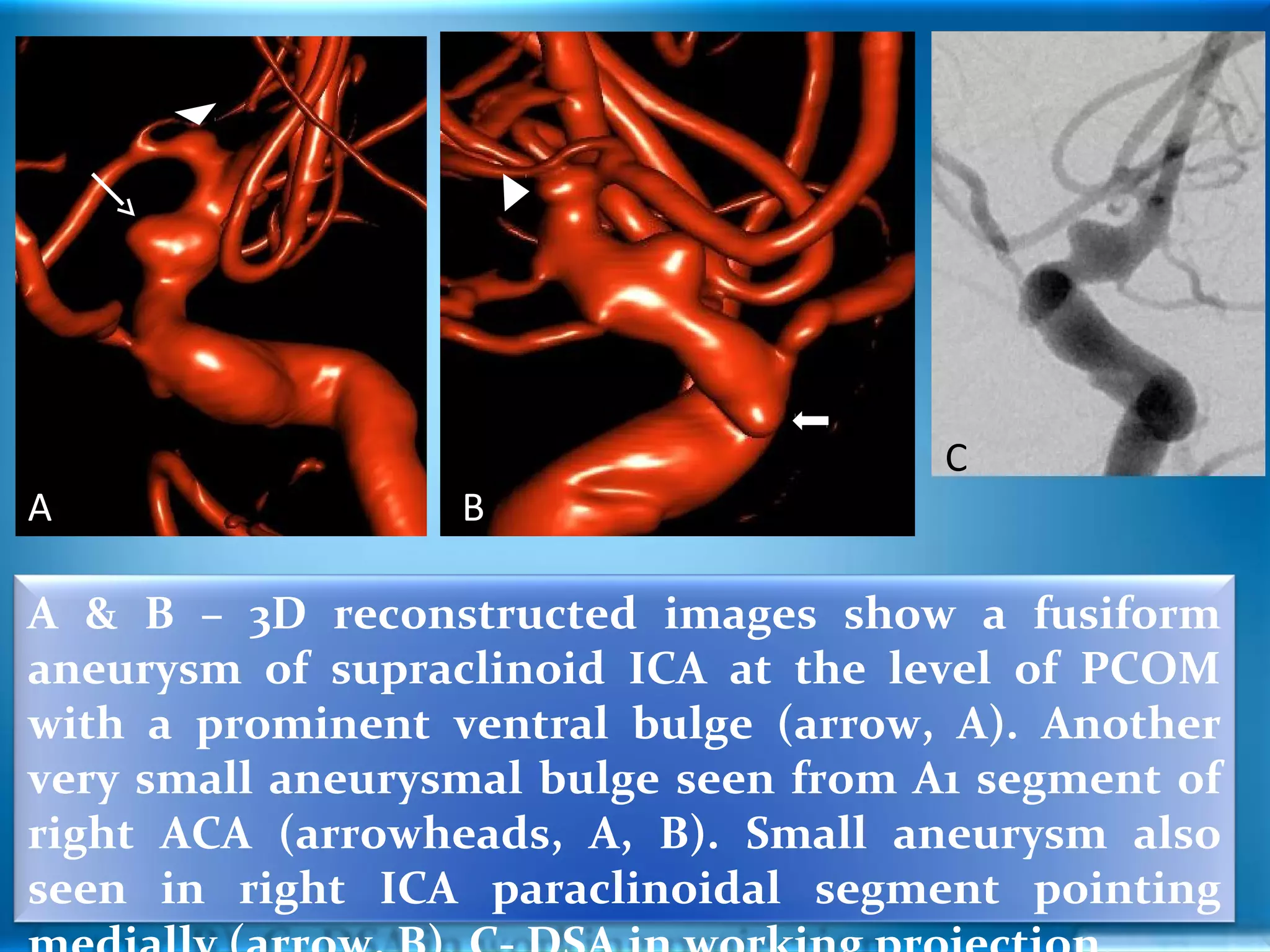Blister & Aneurysm | PPT