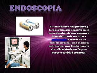 ENDOSCOPIAEs una técnica diagnostica y terapéutica que consiste en la introducción de una cámara o lente dentro de un tubo o endoscopio a través de un orificio natural, una incisión quirúrgica, una lesión para la visualización de un órgano hueco o cavidad corporal.