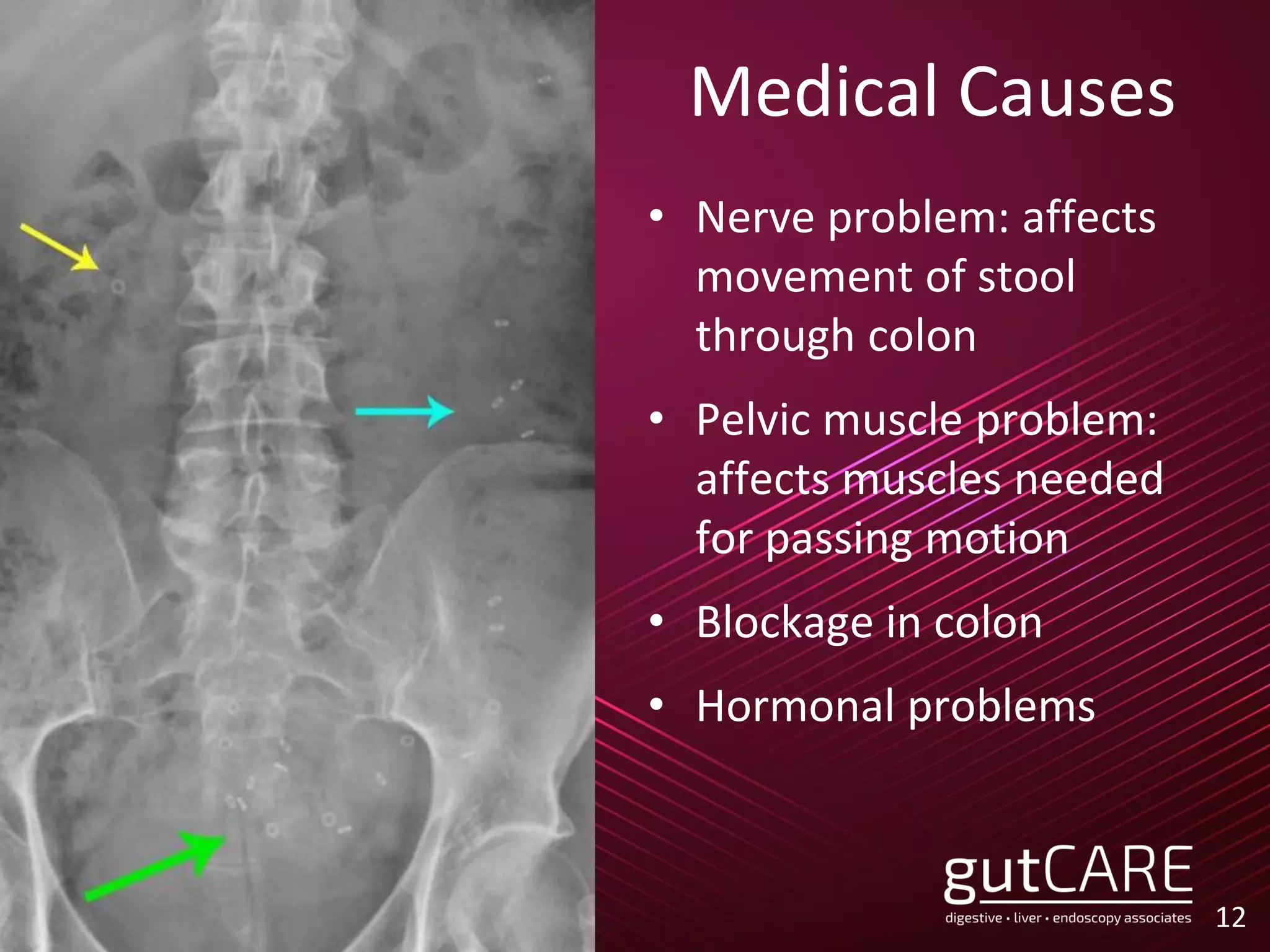 Medical Causes
12
• Nerve problem: affects
movement of stool
through colon
• Pelvic muscle problem:
affects muscles needed
for passing motion
• Blockage in colon
• Hormonal problems
 