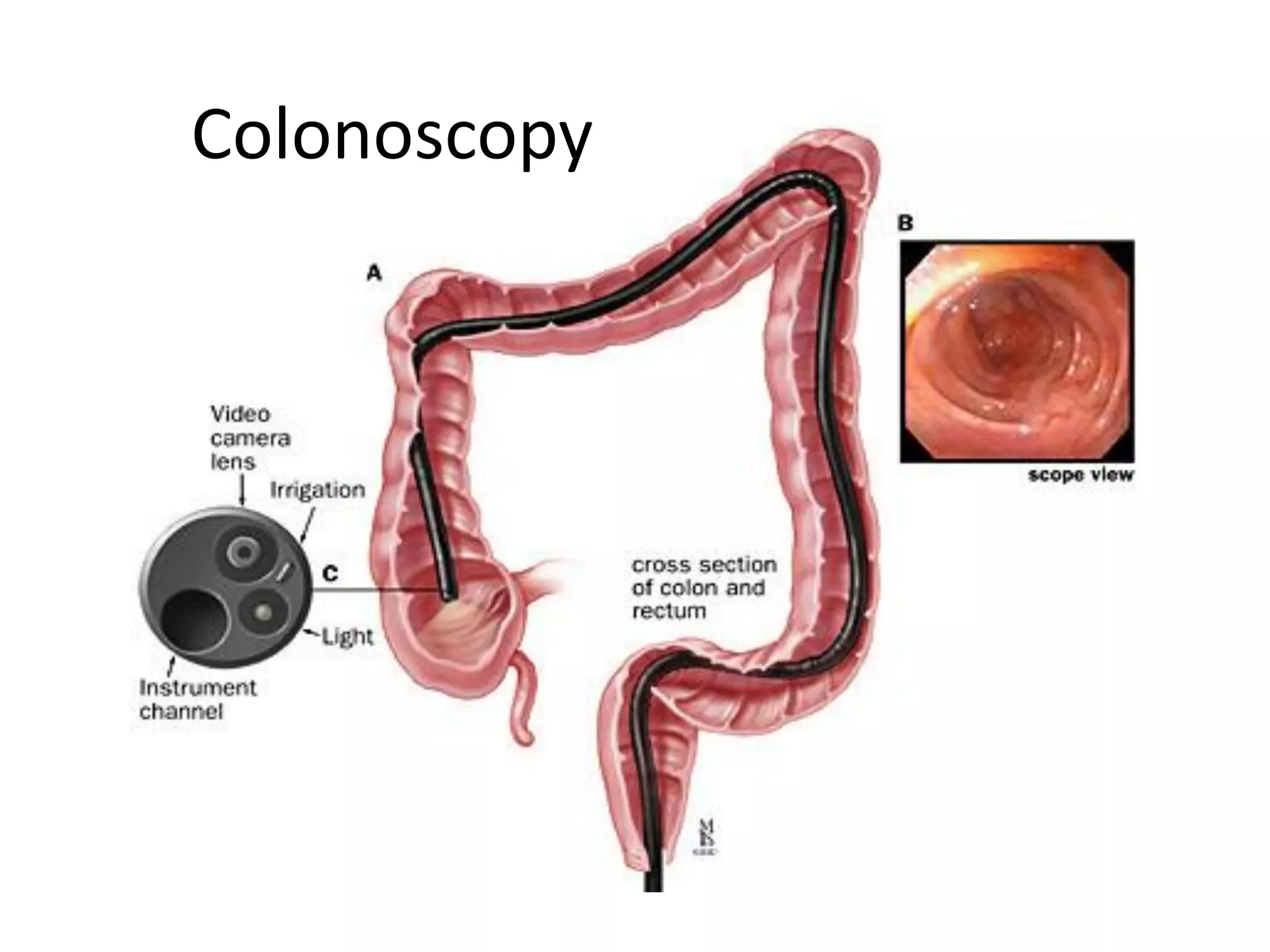 Colonoscopy
22
 