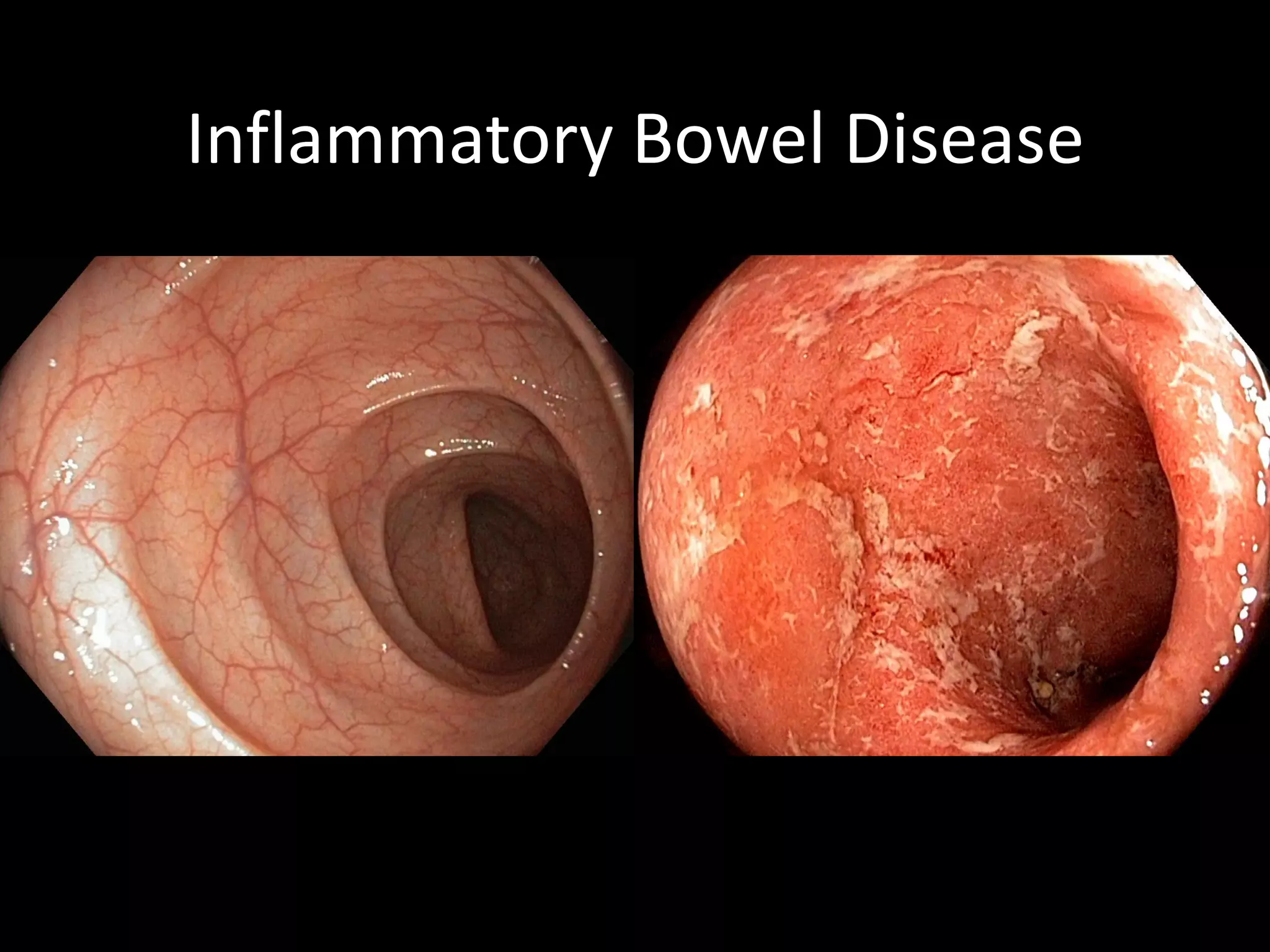 Inflammatory Bowel Disease
 