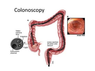 Colonoscopy
22
 
