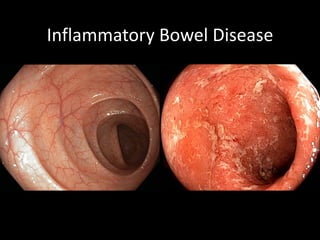 Inflammatory Bowel Disease
 
