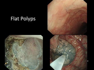 Flat Polyps
32
 