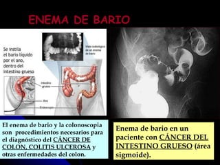 ENEMA DE BARIO Enema de bario en un paciente con  CÁNCER DEL INTESTINO GRUESO  (área sigmoide).  El enema de bario y la colonoscopia son  procedimientos necesarios para el diagnóstico del  CÁNCER DE COLON, COLITIS ULCEROSA  y otras enfermedades del colon.  
