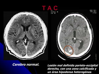 T A C Lesión mal definida parieto-occipital derecha, con una zona calcificada y un área hipodensa heterogénea .  Cerebro normal. 