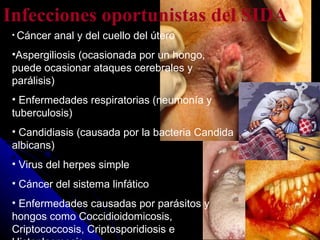 Infecciones oportunistas del SIDA Cáncer anal y del cuello del útero Aspergiliosis (ocasionada por un hongo, puede ocasionar ataques cerebrales y parálisis) Enfermedades respiratorias (neumonía y tuberculosis) Candidiasis (causada por la bacteria Candida albicans) Virus del herpes simple Cáncer del sistema linfático Enfermedades causadas por parásitos y hongos como Coccidioidomicosis, Criptococcosis, Criptosporidiosis e Histoplasmosis. 