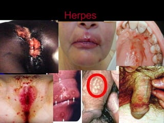 Herpes 