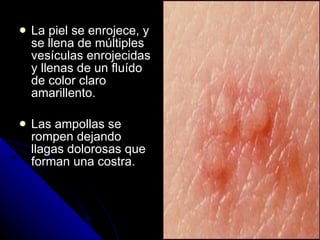 La piel se enrojece, y se llena de múltiples vesículas enrojecidas y llenas de un fluído de color claro amarillento. Las ampollas se rompen dejando llagas dolorosas que forman una costra. 