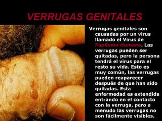 VERRUGAS GENITALES Verrugas genitales  son causadas por un virus llamado el Virus de  Papiloma Humano . Las verrugas pueden ser quitadas, pero la persona tendrá el virus para el resto su vida. Esto es muy común, las verrugas pueden reaparecer después de que han sido quitadas. Esta enfermedad es extendida entrando en el contacto con la verruga, pero a menudo las verrugas no son fácilmente visibles.  