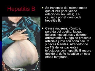 Hepatitis B   Se transmite del mismo modo que el VIH (incluyendo relaciones sexuales). Es causada por el virus de la hepatitis B. Causa n áuseas, vómitos, pérdida del apetito, fatiga, dolores musculares y dolores articulatorios. Luego se presenta  ictericia  junto con orina oscura y heces blandas. Alrededor de un 1% de los pacientes infectados con hepatitis B muere debido al daño hepático en esta etapa temprana. 