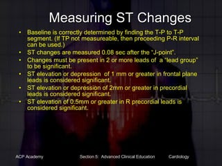 Measuring ST Changes Baseline is correctly determined by finding the T-P to T-P segment. (If TP not measureable, then preceeding P-R interval can be used.) ST changes are measured 0.08 sec after the “J-point”. Changes must be present in 2 or more leads of  a “lead group” to be significant. ST elevation or depression  of 1 mm or greater in frontal plane leads is considered significant. ST elevation or depression of 2mm or greater in precordial leads is considered significant. ST elevation of 0.5mm or greater in R precordial leads is considered significant. 