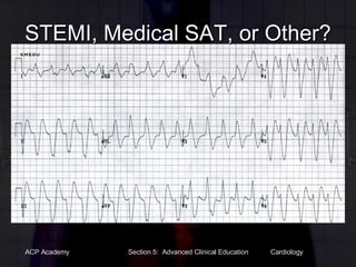 STEMI, Medical SAT, or Other? 