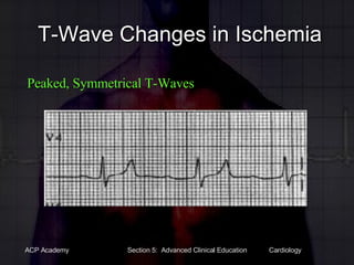 T-Wave Changes in Ischemia   Peaked, Symmetrical T-Waves 