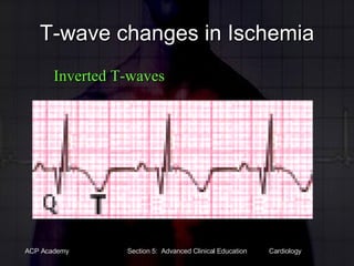 T-wave changes in Ischemia Inverted T-waves 