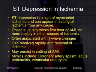 ST Depression in Ischemia ST depression is a sign of myocardial ischemia and can appear in setting of ischemia from any cause. Onset is usually within first hour of AMI, or more rapidly in other causes of ischemia. Often associated with T-wave changes Can resolved rapidly with reversal of ischemia. May persist in setting of AMI. Mimics include: Coronary artery spasm, acute pericarditis, ventricular aneurysm. 