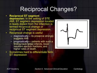 Reciprocal Changes? Reciprocal ST segment depression:  In the setting of STE AMI, ST segment depression located in leads distant from the infarction is termed reciprocal change or reciprocal ST segment depression. Reciprocal change is useful  diagnostically — its presence strongly suggests AMI prognostically — patients with such a finding have larger infarcts, lower resultant ejection fractions, and higher rates of death. Sometimes hard to differentiate form ST depression 