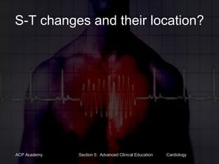 S-T changes and their location? 