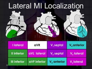 Lateral MI Localization aVF inferior III inferior V 3  anterior V 6  lateral aVL  lateral II inferior V 2  septal V 5  lateral aVR I lateral V 1  septal V 4  anterior 
