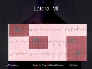 Lateral MI 