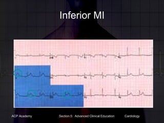 Inferior MI 