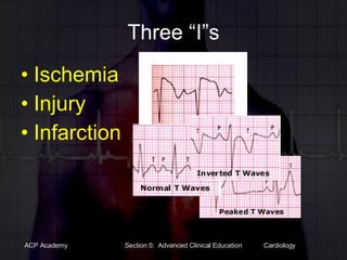 Three “I”s Ischemia Injury  Infarction 