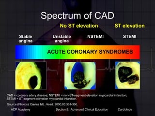Spectrum of CAD No ST elevation ST elevation Unstable angina NSTEMI STEMI Stable angina Source (Photos): Davies MJ.  Heart . 2000;83:361-366. CAD = coronary artery disease; NSTEMI = non-ST-segment elevation myocardial infarction; STEMI = ST-segment-elevation myocardial infarction. ACUTE CORONARY SYNDROMES 