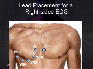 Lead Placement for a  Right-sided ECG 