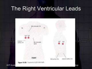The Right Ventricular Leads 
