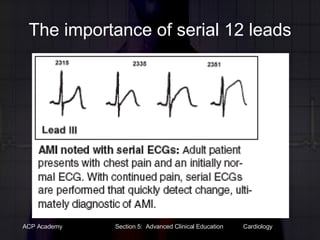 The importance of serial 12 leads 