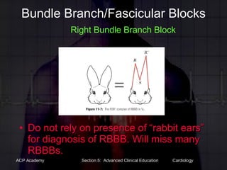 Bundle Branch/Fascicular Blocks   Right Bundle Branch Block Do not rely on presence of “rabbit ears” for diagnosis of RBBB. Will miss many RBBBs. 