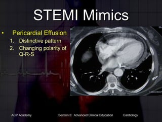 STEMI Mimics Pericardial Effusion Distinctive pattern Changing polarity of Q-R-S 