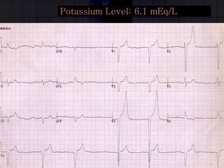 Potassium Level: 6.1 mEq/L 
