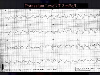 Potassium Level: 7.2 mEq/L 