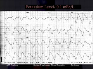 Potassium Level: 9.1 mEq/L 
