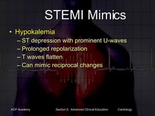 STEMI Mimics Hypokalemia ST depression with prominent U-waves Prolonged repolarization T waves flatten Can mimic reciprocal changes 