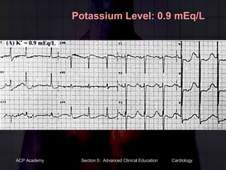 Potassium Level: 0.9 mEq/L 