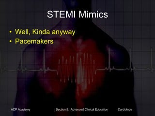 STEMI Mimics Well, Kinda anyway Pacemakers 