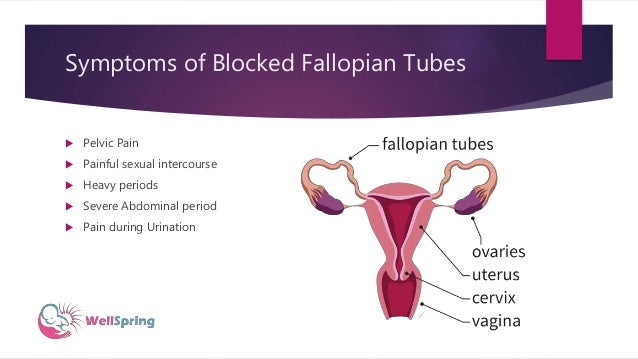 Blocked fallopian tubes symptoms, causes and treatment