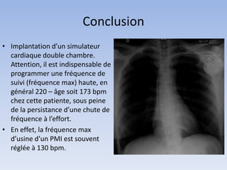 Conclusion
• Implantation d’un simulateur
cardiaque double chambre.
Attention, il est indispensable de
programmer une fréquence de
suivi (fréquence max) haute, en
général 220 – âge soit 173 bpm
chez cette patiente, sous peine
de la persistance d’une chute de
fréquence à l’effort.
• En effet, la fréquence max
d’usine d’un PMI est souvent
réglée à 130 bpm.
 