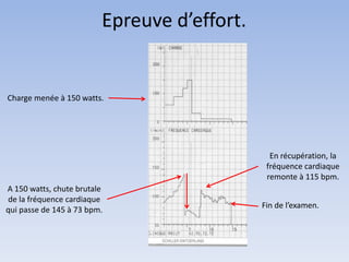 Epreuve d’effort.
Charge menée à 150 watts.
A 150 watts, chute brutale
de la fréquence cardiaque
qui passe de 145 à 73 bpm.
En récupération, la
fréquence cardiaque
remonte à 115 bpm.
Fin de l’examen.
 
