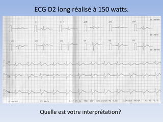 ECG D2 long réalisé à 150 watts.
Quelle est votre interprétation?
 