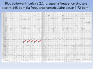 Bloc atrio-ventriculaire 2:1 lorsque la fréquence sinusale
atteint 145 bpm (la fréquence ventriculaire passe à 72 bpm).
P PP PP
 