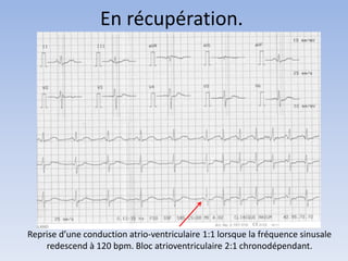 En récupération.
Reprise d’une conduction atrio-ventriculaire 1:1 lorsque la fréquence sinusale
redescend à 120 bpm. Bloc atrioventriculaire 2:1 chronodépendant.
 