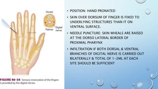 • POSITION: HAND PRONATED
• SKIN OVER DORSUM OF FINGER IS FIXED TO
UNDERLYING STRUCTURES THAN IT ON
VENTRAL SURFACE.
• NEEDLE PUNCTURE: SKIN WHEALS ARE RAISED
AT THE DORSO LATERAL BORDER OF
PROXIMAL PHARYNX
• INFILTRATION IF BOTH DORSAL & VENTRAL
BRANCHES OF DIGITAL NERVE IS CARRIED OUT
BILATERALLY & TOTAL OF 1-2ML AT EACH
SITE SHOULD BE SUFFICIENT
 