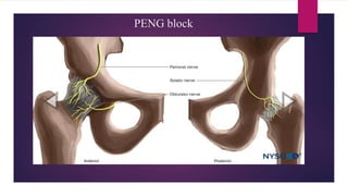 PENG block
• Pericapsular nerve group block - Giron Arango
• Plane block
• Obturator nerve (ON), accessory obturator nerve (AON) and femoral nerve (FN) - major
contribution in innervation of anterior hip capsule
Indication: Preoperative and perioperative analgesia for fracture neck of femur
Possibly can be used for postoperative analgesia following total hip arthroplasty
 