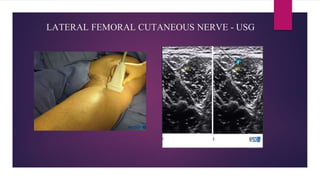LATERAL FEMORAL CUTANEOUS NERVE - USG
 