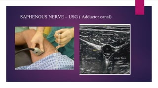 SAPHENOUS NERVE – USG ( Adductor canal)
 