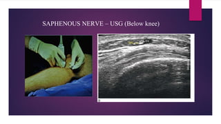SAPHENOUS NERVE – USG (Below knee)
 