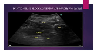 SCIATIC NERVE BLOCK (ANTERIOR APPROACH): Van der Beek
Techniques to locate the sciatic nerve:
• Drawing an imaginary isosceles triangle with the femur as its apex, the
femoral vessels as one corner, the sciatic nerve will lie at the other
corner
 